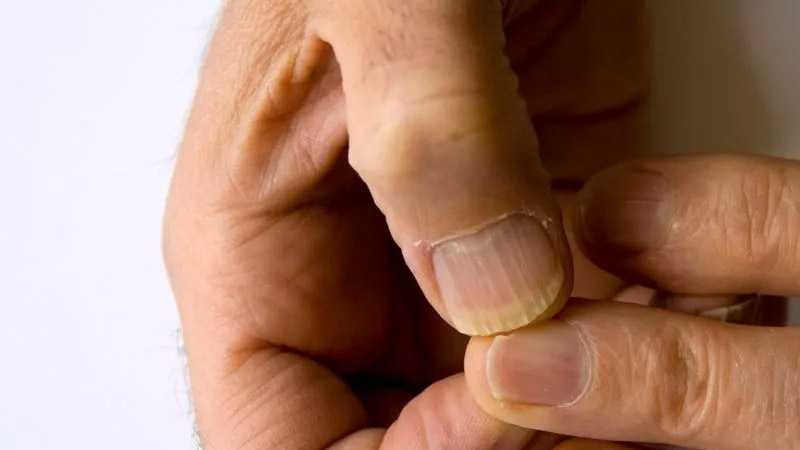  Nail Changes Linked to Rare Cancer Syndrome, Study Warns