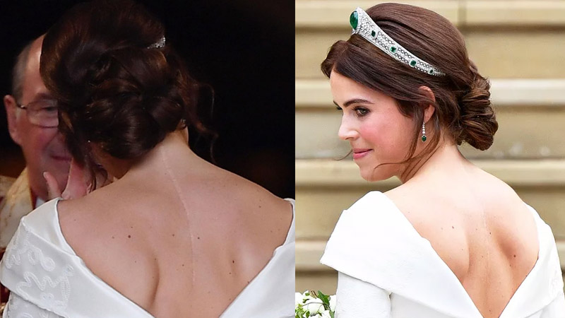  Princess Eugenie shares her ‘scar and encourage’ as she marks International Scoliosis Awareness Day